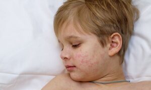 Protecting Texas Families: Children’s Health Leads Measles Education Effort